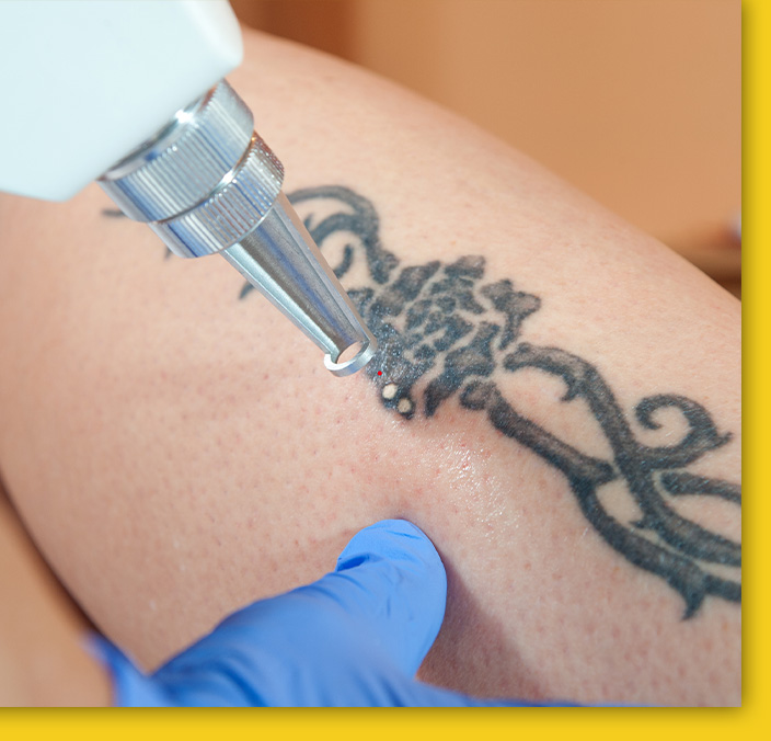 Tattoo Removal